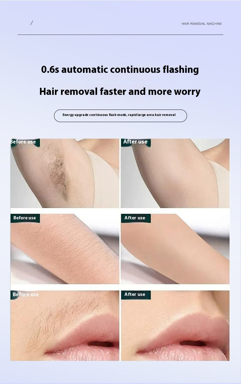 Laser Freezing Hair Removal Device